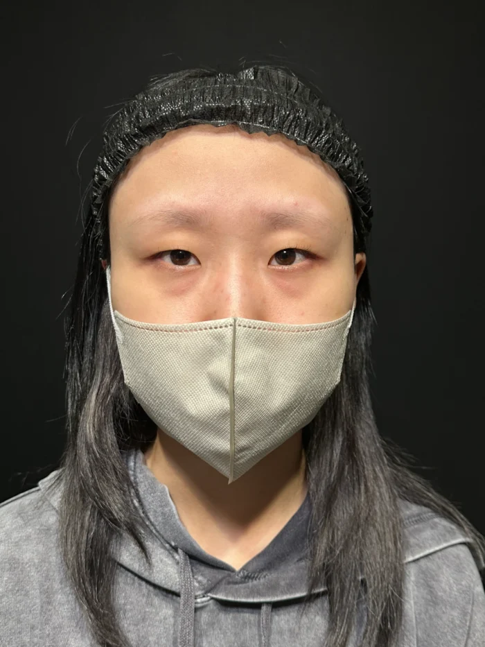 eクリニックのクマ取り 経結膜脱＋脂肪注入の症例術前写真（名医の脇谷雄一朗が執刀）