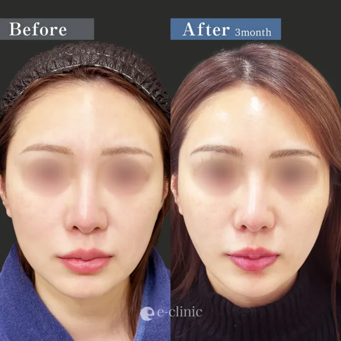 小顔脂肪吸引＋糸リフトの症例写真（名医の伊藤渉医師が執刀）