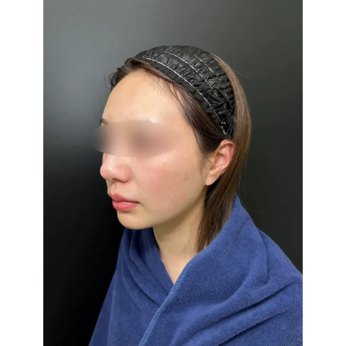 小顔脂肪吸引＋糸リフト術前の症例写真（名医の伊藤渉医師が執刀）