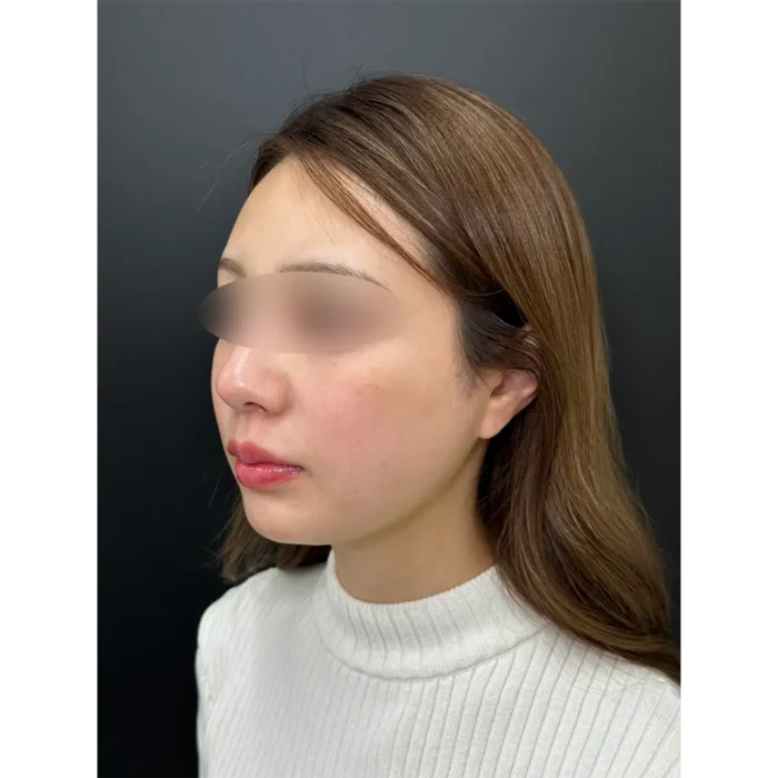 小顔脂肪吸引＋糸リフト術後1週間の症例写真（名医の伊藤渉医師が執刀）