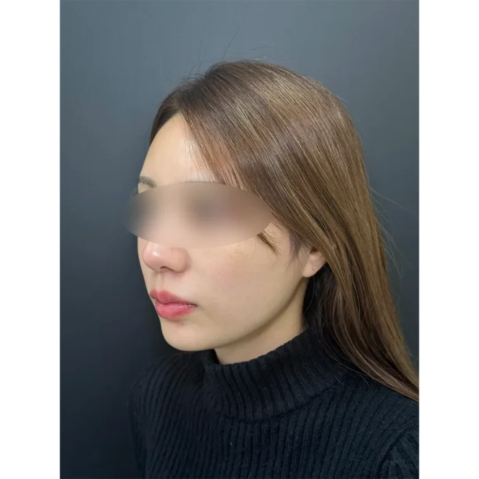 小顔脂肪吸引＋糸リフト術後2週間の症例写真（名医の伊藤渉医師が執刀）