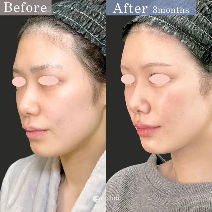 脂肪注入症例写真（名医の田嶋隼也医師が執刀）