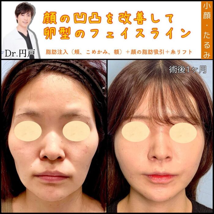 脂肪注入と顔の脂肪吸引と糸リフトの症例写真