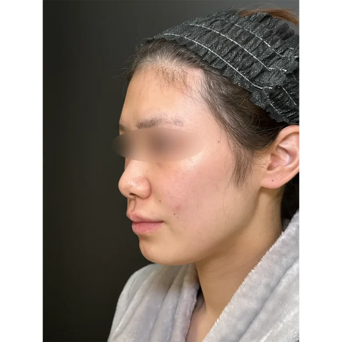 脂肪注入術前症例写真（名医の田嶋隼也医師が執刀）