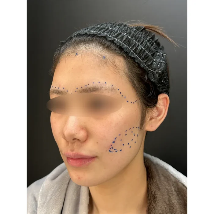 脂肪注入術前デザイン症例写真（名医の田嶋隼也医師が執刀）