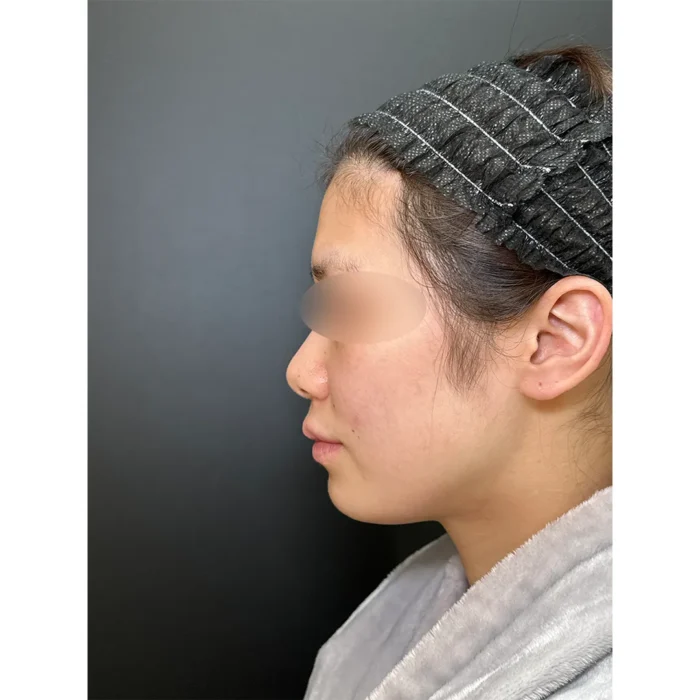 脂肪注入術前症例写真（名医の田嶋隼也医師が執刀）