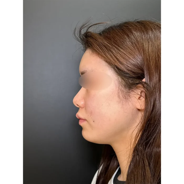 脂肪注入術直後の症例写真（名医の田嶋隼也医師が執刀）