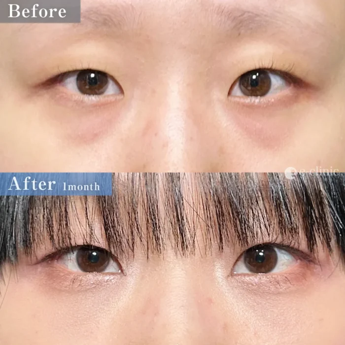 クマ取り（経結膜脱脂＋脂肪注入）（名医の脇谷雄一朗医師が執刀）