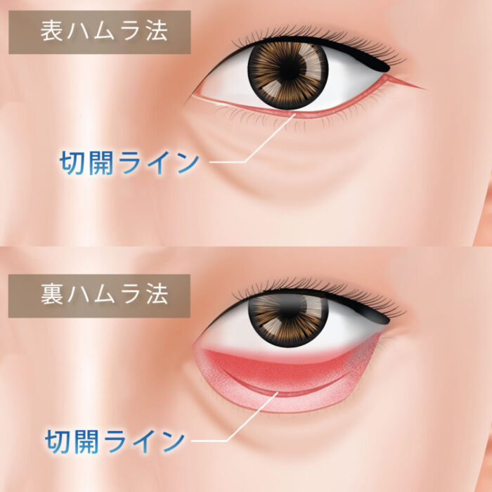 eクリニックのクマ取り表ハムラ法と裏ハムラ法の図解（経結膜脱脂の図解）