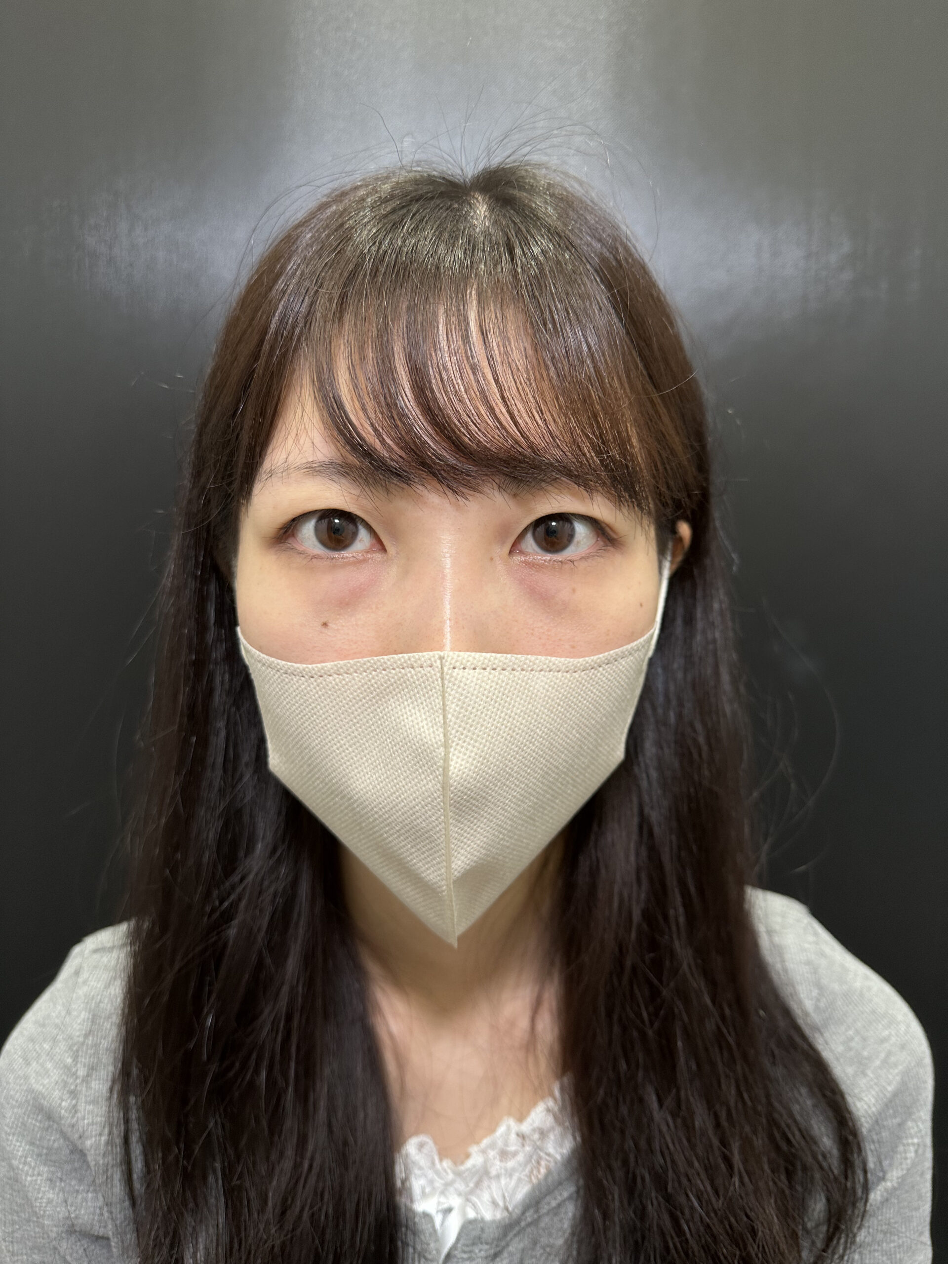 eクリニックの裏ハムラ法の術前症例写真（名医の脇谷雄一朗医師が執刀）