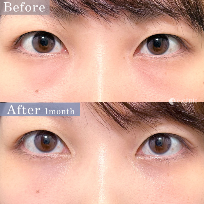 eクリニックの裏ハムラ法の症例写真（名医の脇谷雄一朗医師が執刀）