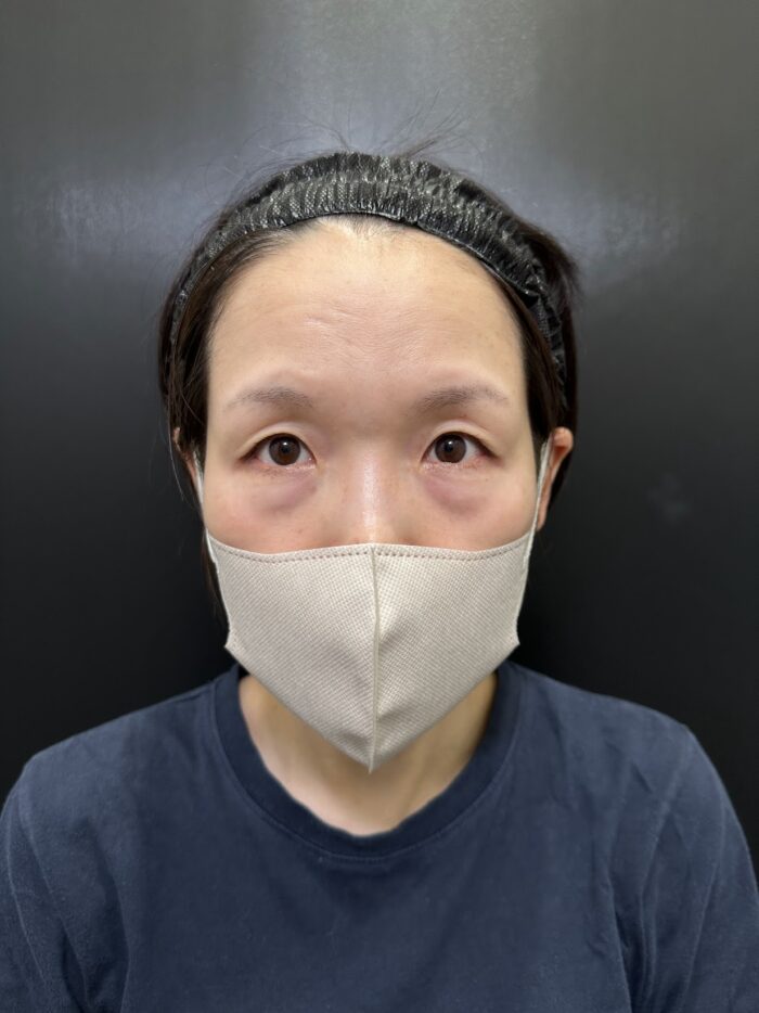 eクリニックのクマ取り 裏ハムラ法の症例術前写真（名医の脇谷雄一朗医師が執刀）