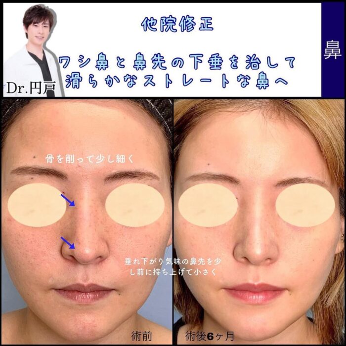 鷲鼻と鼻先の他院修正の症例写真