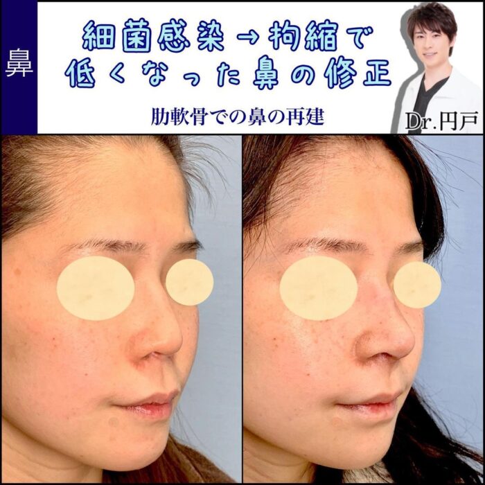 鼻の他院修正の症例写真