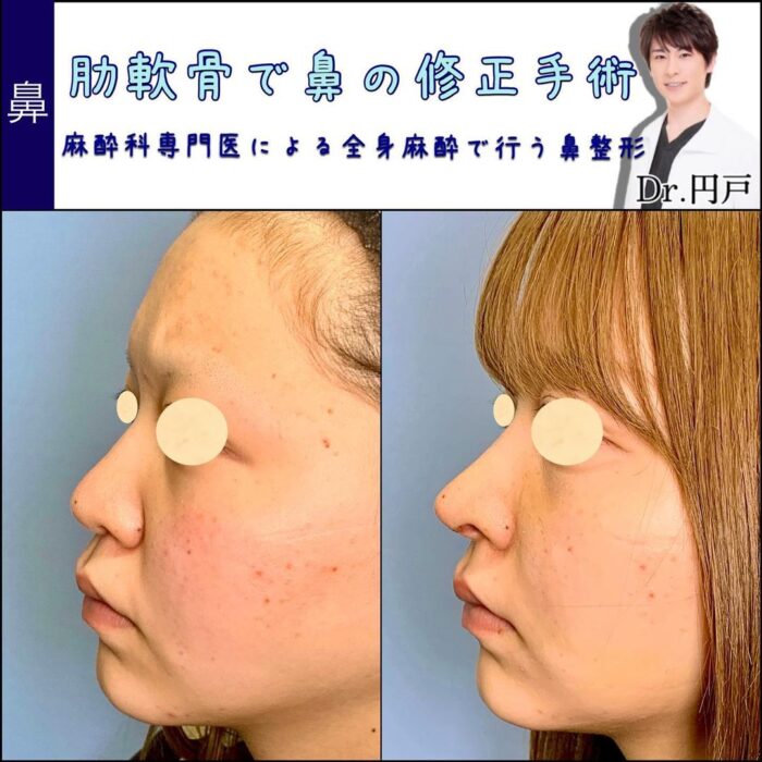鼻の修正手術の症例写真