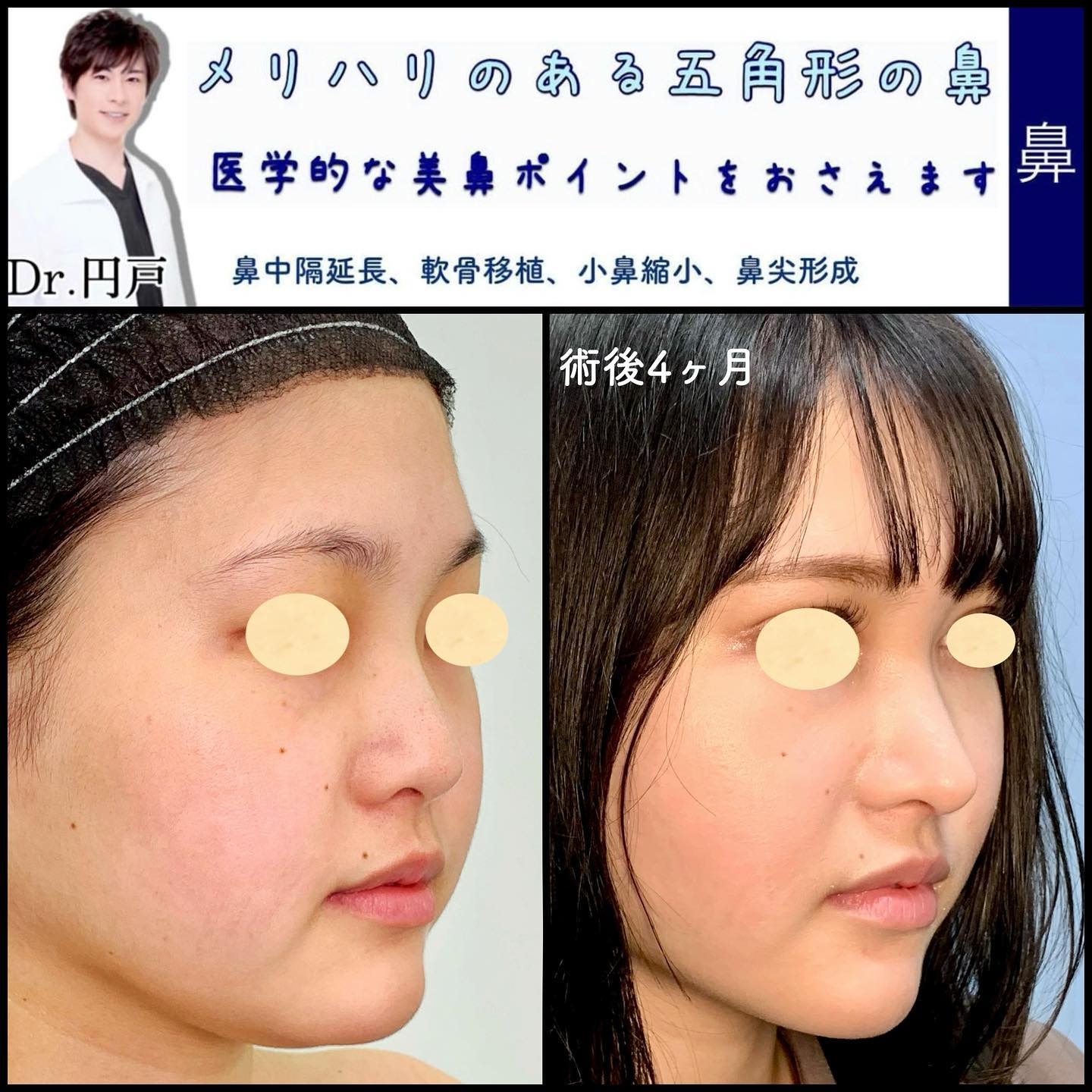 鼻中隔延長と軟骨移植と小鼻縮小と鼻尖形成症例写真 (1)