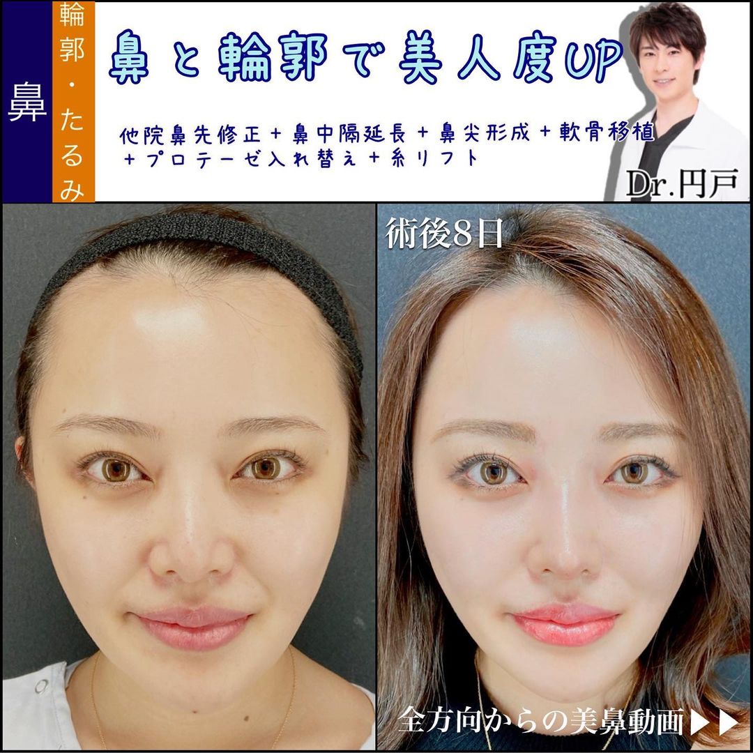 鼻先の修正手術と鼻中隔延長と鼻尖形成と軟骨移植とプロテーゼの入れ替えと糸リフトの症例写真