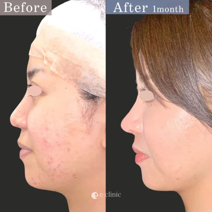 鼻整形（鼻尖形成3D＋耳介軟骨移植）（126）