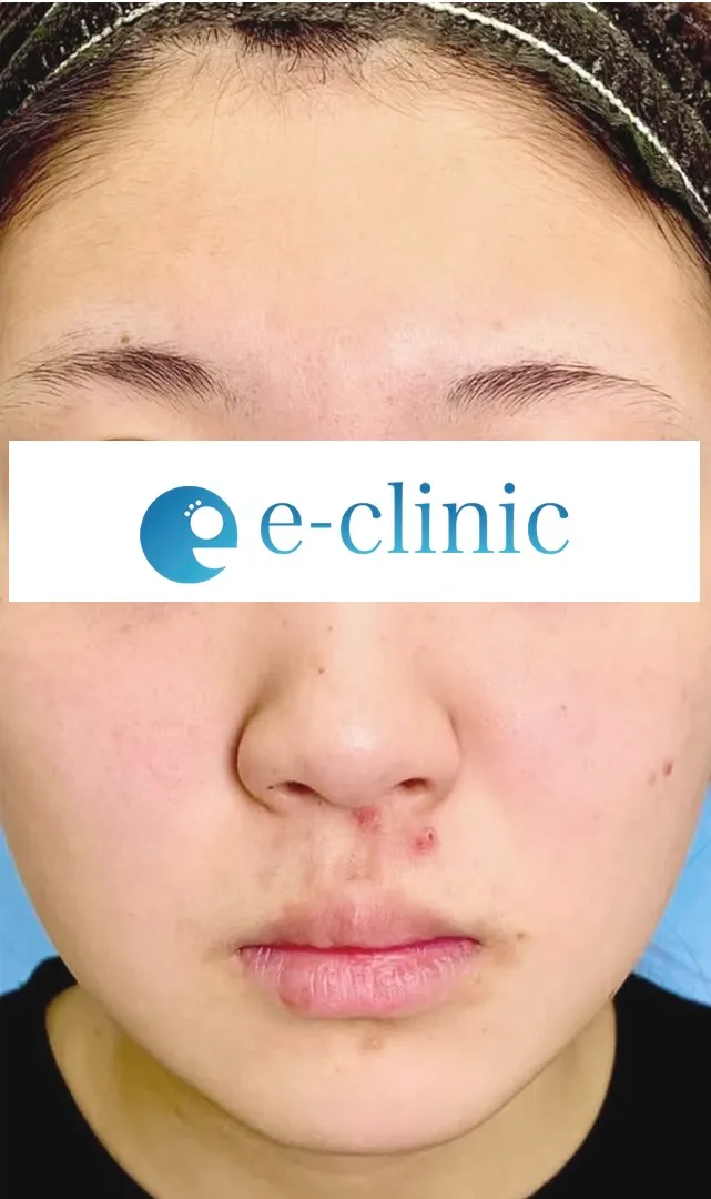 eクリニック大阪梅田院の鼻整形（鼻フル）の症例術前写真（名医の円戸望医師が執刀）
・鼻尖形成3D法
・鼻尖部軟骨移植または軟骨膜移植
・鼻中隔延長　保存軟骨
・超音波脂肪吸引Ultra-Z　顎下