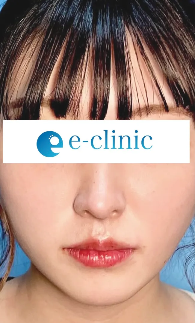 eクリニック大阪梅田院の鼻整形（鼻フル）の症例術後写真（名医の円戸望医師が執刀）
・鼻尖形成3D法
・鼻尖部軟骨移植または軟骨膜移植
・鼻中隔延長　保存軟骨
・超音波脂肪吸引Ultra-Z　顎下