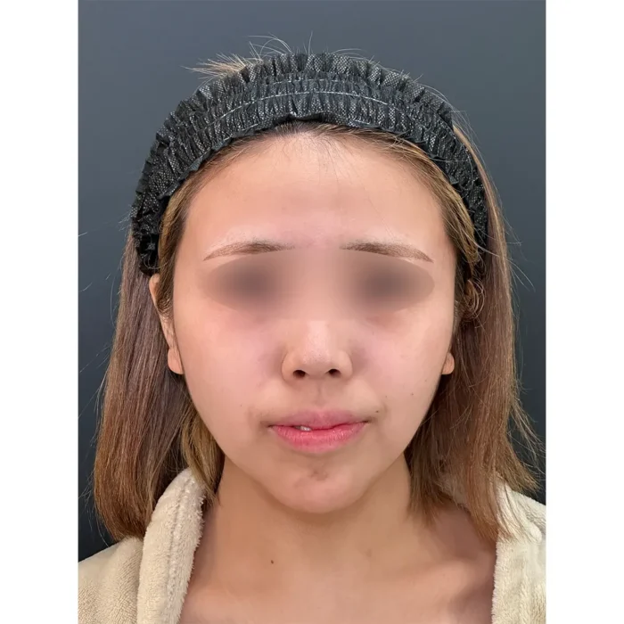 鼻整形（鼻尖形成3D法＋耳介軟骨移植＋鼻柱下降＋プロテーゼ）術前_（名医の田島隼也医師が執刀）