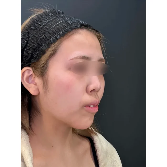 鼻整形（鼻尖形成3D法＋耳介軟骨移植＋鼻柱下降＋プロテーゼ）術前_（名医の田島隼也医師が執刀）