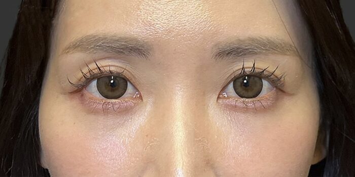 クマ取り_経結膜脱脂＋脂肪注入術後1ヶ月（名医の劉奕陽医師が執刀）（47）