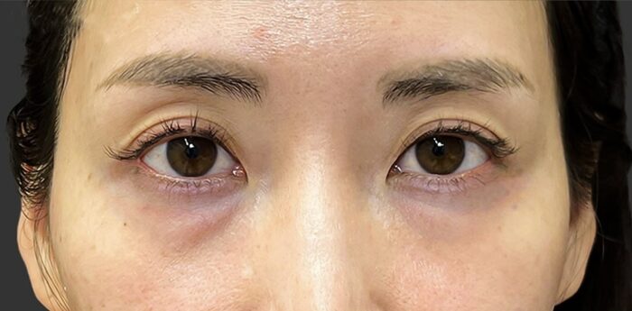 クマ取り_経結膜脱脂＋脂肪注入術前（名医の劉奕陽医師が執刀）（47）