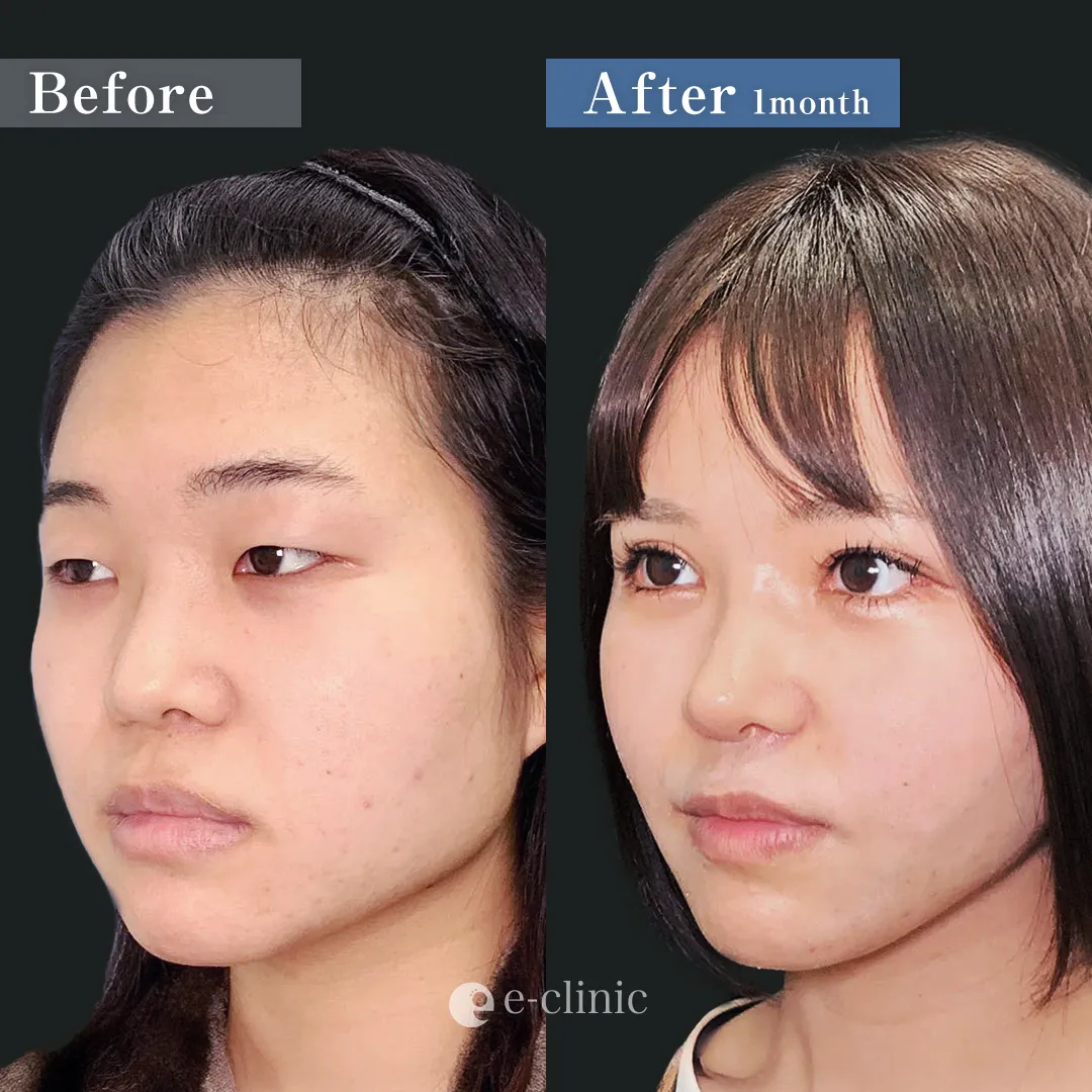 目フル+鼻フル+輪郭整形_(目頭、下瞼拡大、目尻靱帯移動、眼瞼下垂、全切開)+(小鼻縮小、鼻尖形成+軟骨移植+鼻中隔延長+オステオポール除去)+(頬顎脂肪吸引)+糸リフト(円戸望)(174)