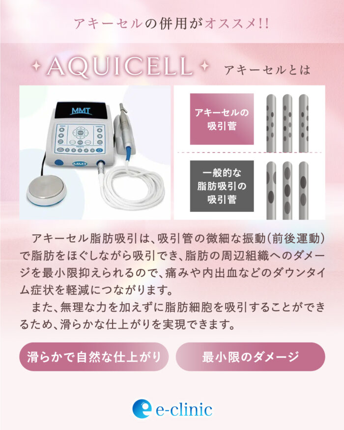 アキーセル脂肪吸引の詳細