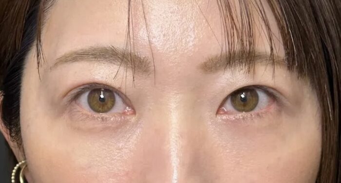 クマ取り_裏ハムラ法＋二重整形_自然癒着法術後1ヶ月（劉奕陽）（45）