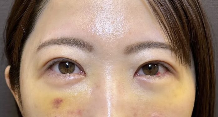クマ取り_裏ハムラ法＋二重整形_自然癒着法術後1週間（劉奕陽）（45）