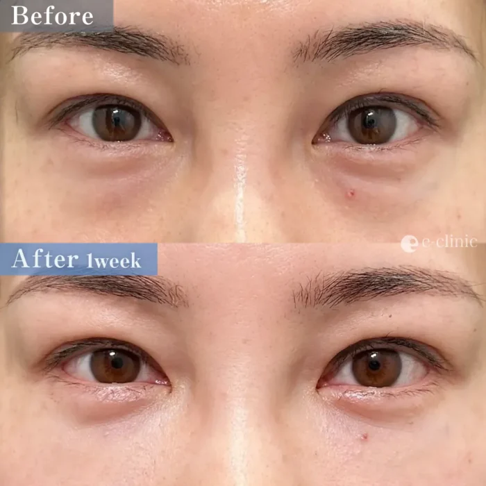 クマ取り_裏ハムラ（脇谷雄一朗）（193）