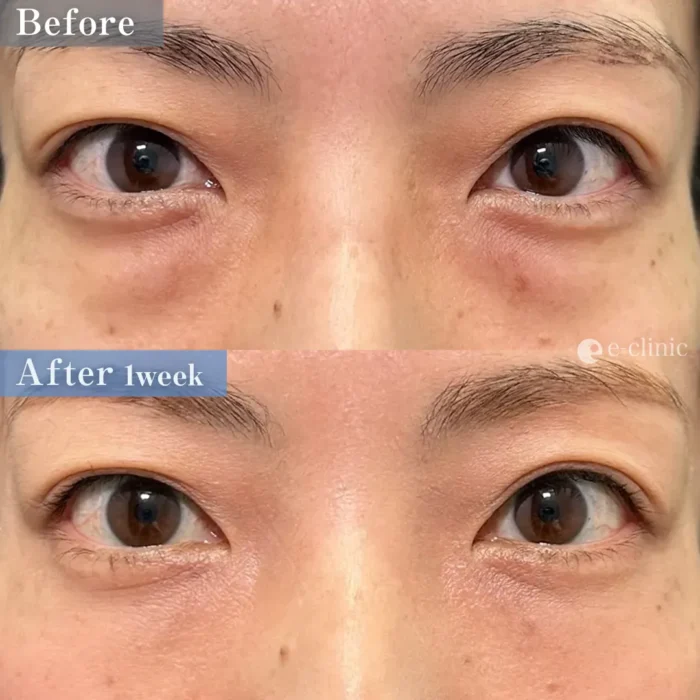 クマ取り_裏ハムラ（脇谷雄一朗）（194）