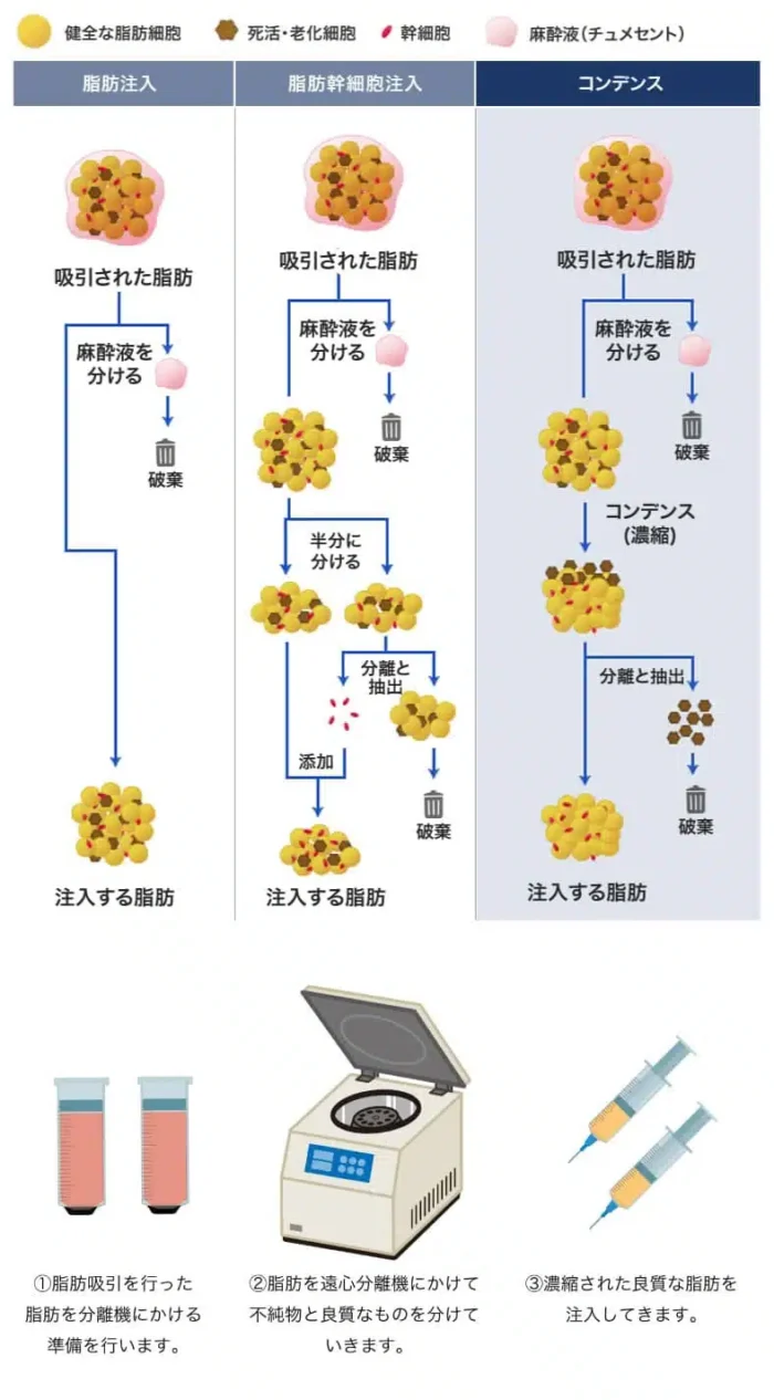 コンデンス豊胸図解