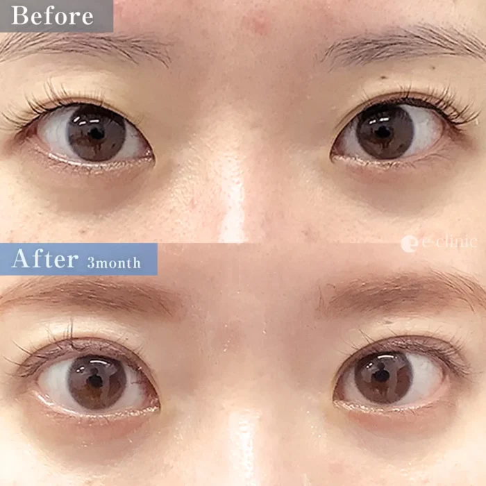 二重整形_二重全切開（切開時埋没抜糸）（飯田秀夫）（84）