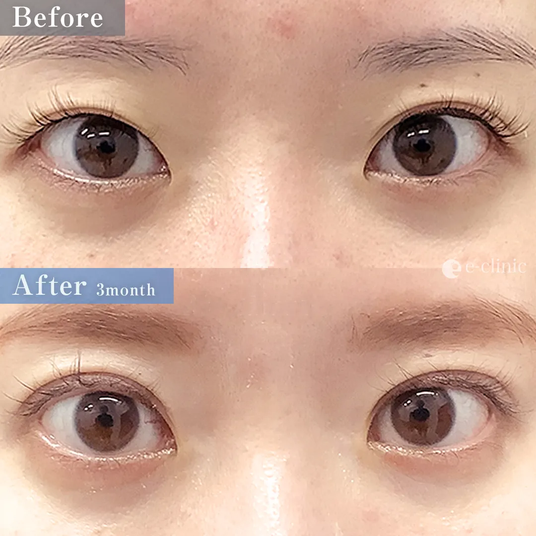 二重整形_二重全切開（切開時埋没抜糸）（飯田秀夫）（84）