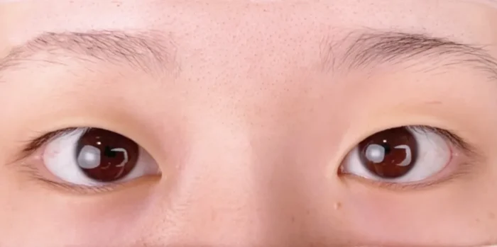 二重整形_埋没法 自然癒着法術前（劉奕陽）（46）