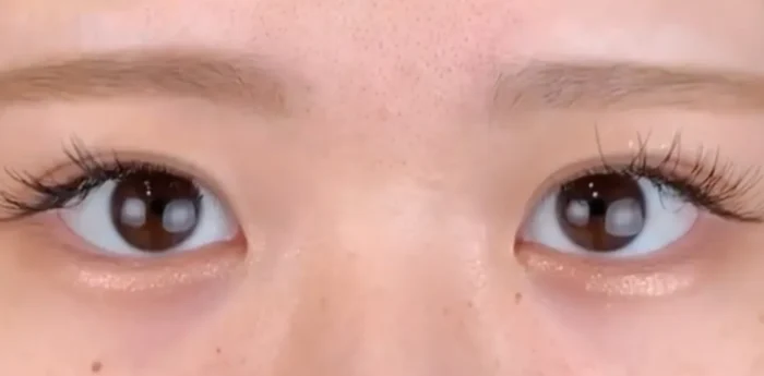 二重整形_埋没法 自然癒着法術後1ヶ月（劉奕陽）（46）