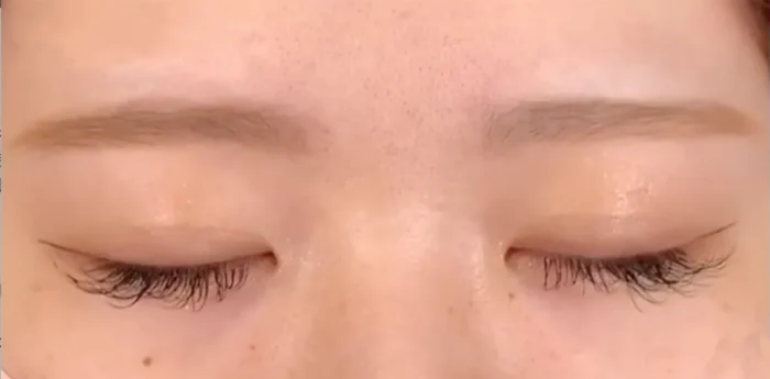 二重整形_埋没法 自然癒着法術閉眼（劉奕陽）（46）