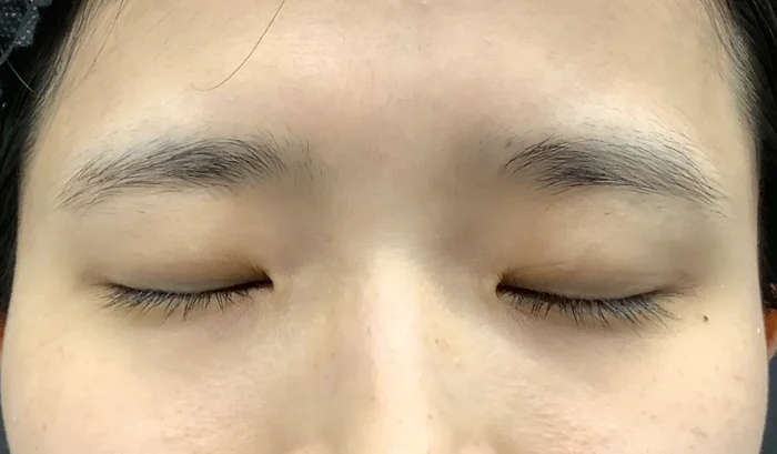 二重整形＋眼瞼下垂_たるみ取り併用全切開二重術＋軽度眼瞼下垂術前閉眼（飯田秀夫）（85）