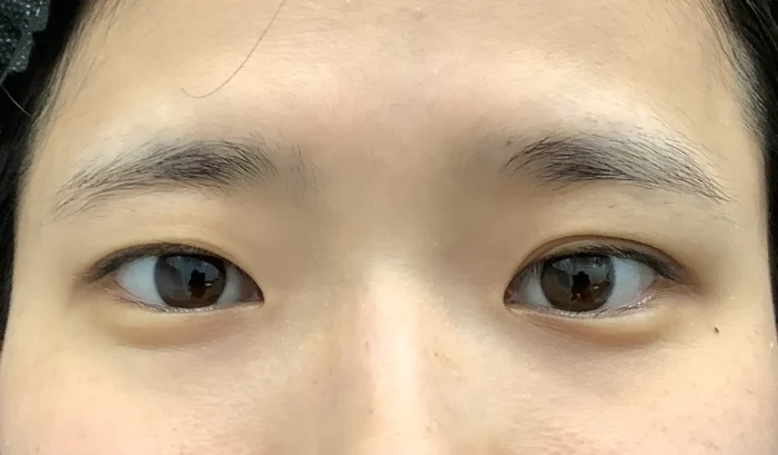 二重整形＋眼瞼下垂_たるみ取り併用全切開二重術＋軽度眼瞼下垂術前（飯田秀夫）（85）