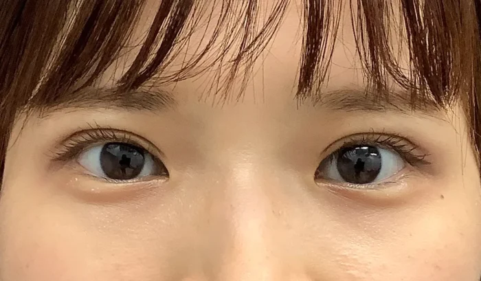 二重整形＋眼瞼下垂_たるみ取り併用全切開二重術＋軽度眼瞼下垂術後3ヶ月（飯田秀夫）（85）