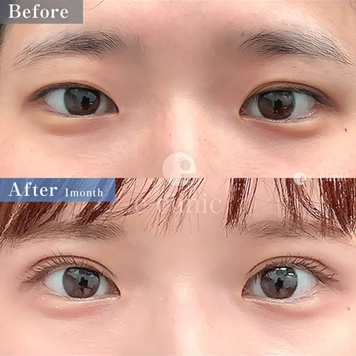 二重整形＋眼瞼下垂_たるみ取り併用全切開二重術＋軽度眼瞼下垂（飯田秀夫）（85）