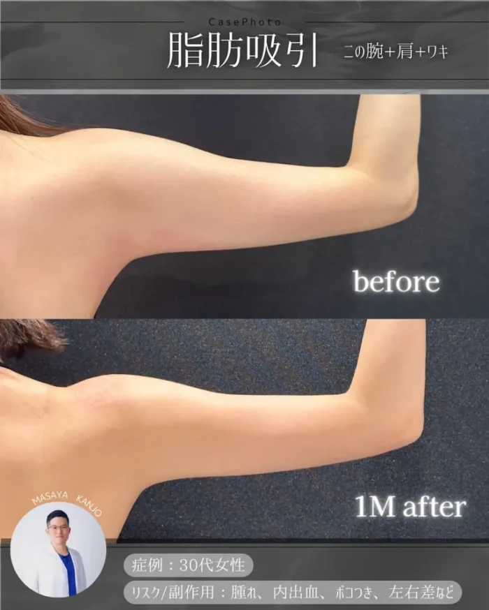 勘定正哉医師_脂肪吸引の症例（二の腕＋肩＋脇）