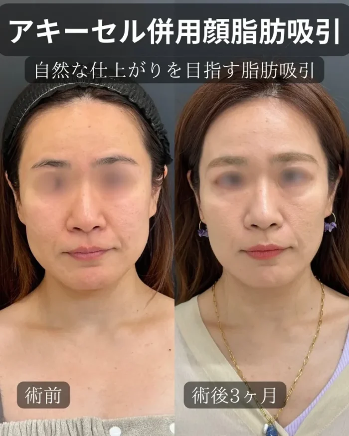 勘定正哉医師_脂肪吸引の症例3