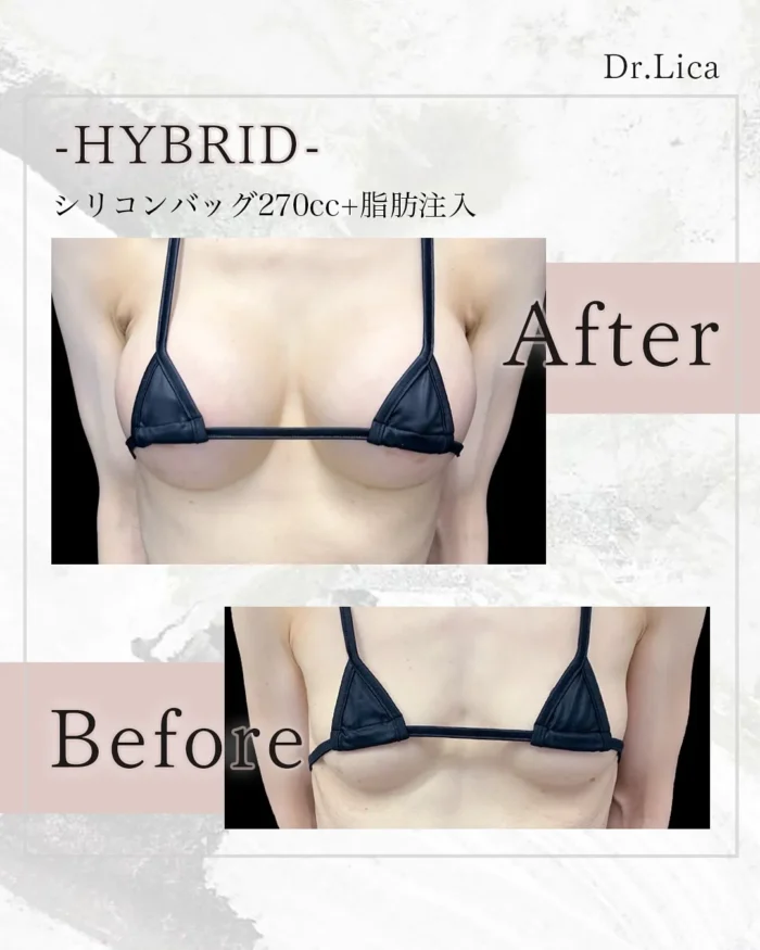田中里佳医師_ハイブリッド豊胸症例