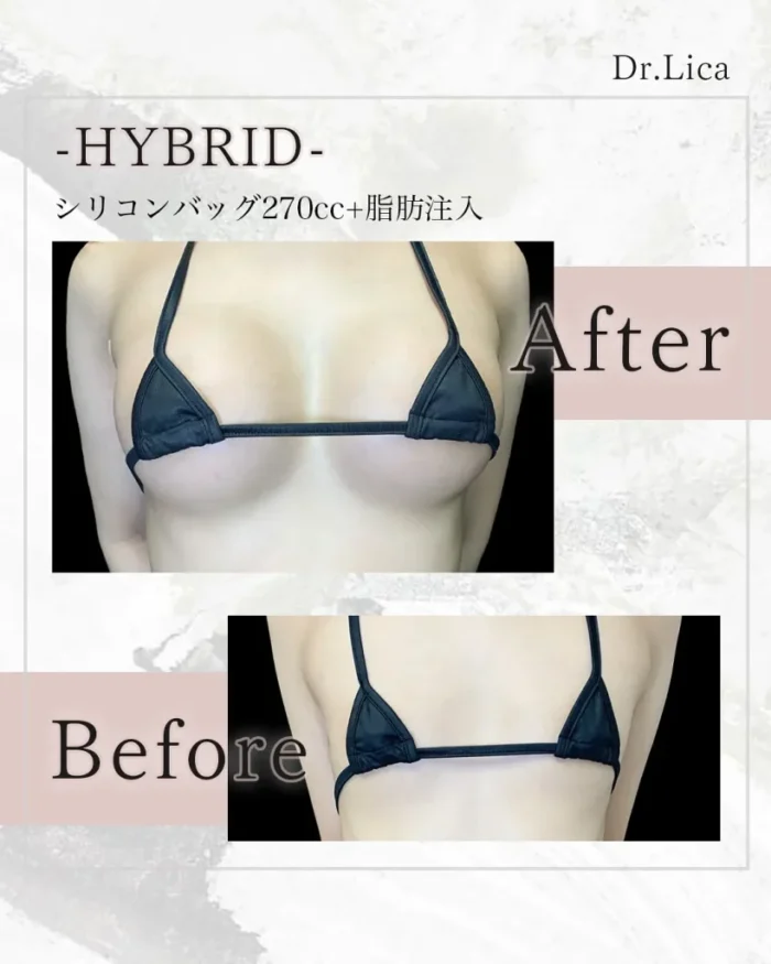 田中里佳医師_ハイブリッド豊胸症例