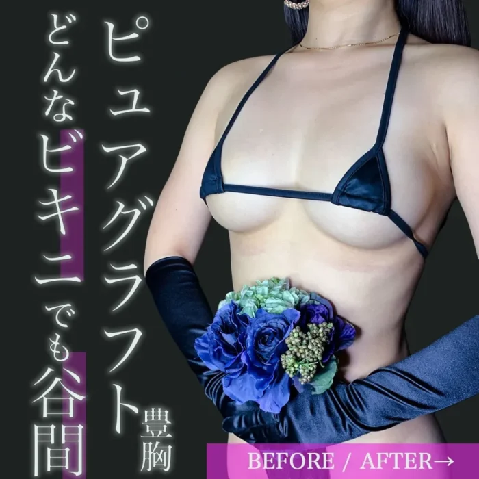 田中里佳医師_ピュアグラフト豊胸の症例