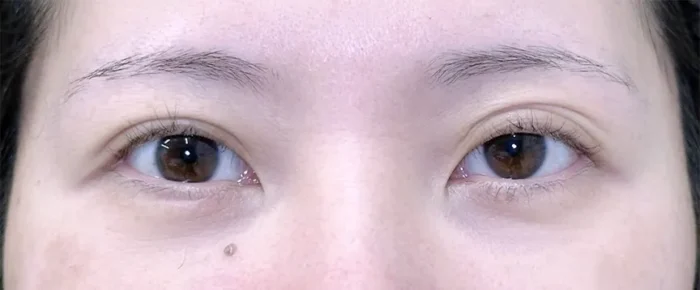 目元切開_目尻切開＋タレ目形成皮膚＋結膜術前（坂本優衣）（28）